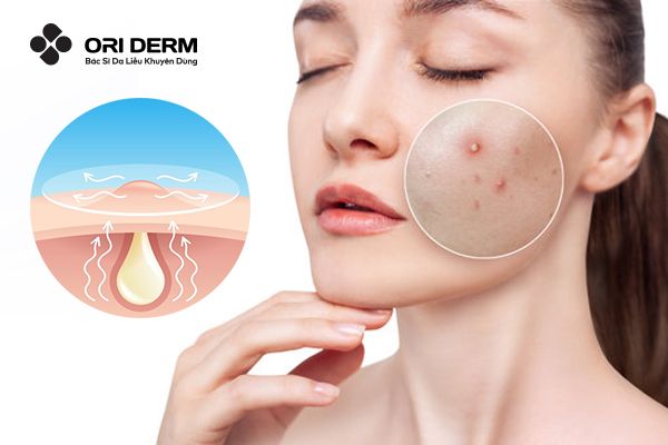 Cơ chế hoạt động của thuốc gom cồi mụn