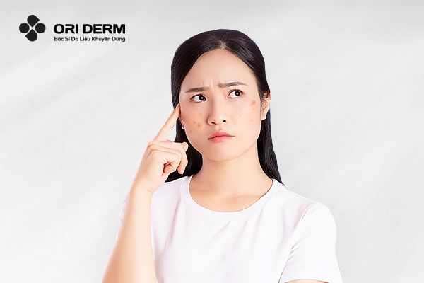 Chăm Sóc Da Mụn: Nên Bôi Trị Mụn Trước Hay Dưỡng Ẩm Trước Thì Tốt Hơn?