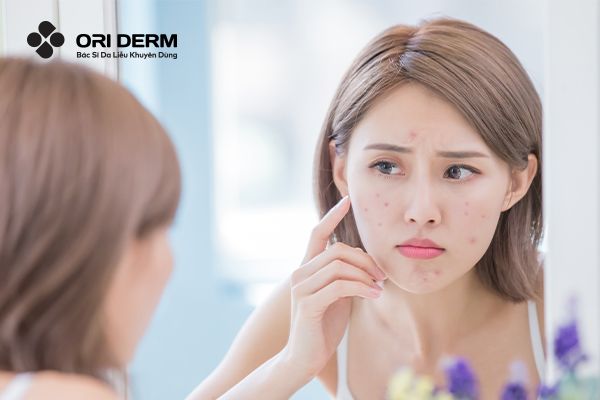 Vì sao cần chọn nước tẩy trang riêng cho da dầu mụn?