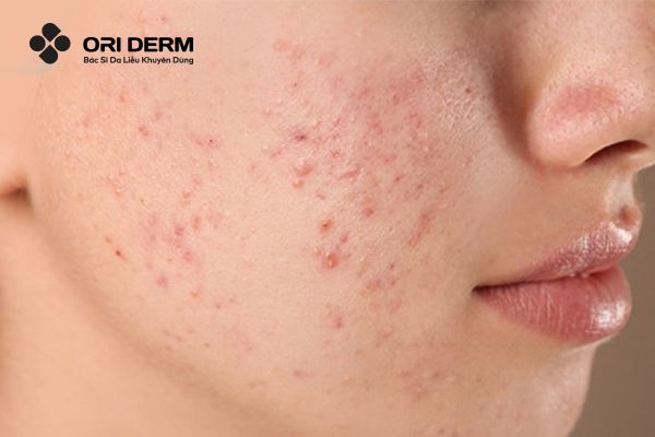 BHA đẩy mụn viêm