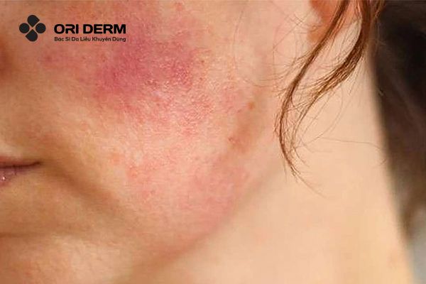 Bị đẩy mụn ồ ạt do dị ứng AHA