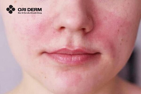 Sau khi peel da bị đỏ rát có nguy hiểm không?