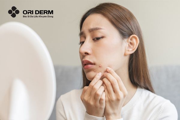 Bị mụn viêm có nên dùng BHA không?