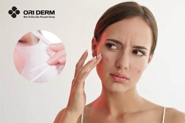 Bị mụn viêm có nên peel da không?