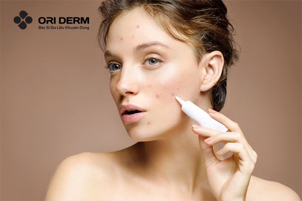 Bôi kem trị mụn