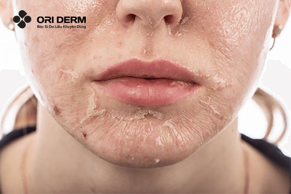 Peel da là gì? Tác dụng của Peel da trong điều trị mụn