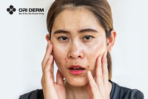 Nguyên nhân và cách khắc phục tình trạng da dầu mụn nhạy cảm