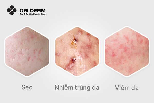 Các biến chứng của mụn bọc