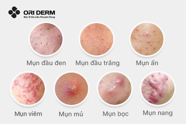Hình ảnh các loại mụn phổ biến