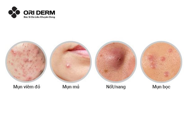 Các loại mụn ẩn viêm dưới da phổ biến