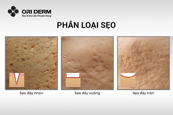 Các loại sẹo rỗ thường gặp