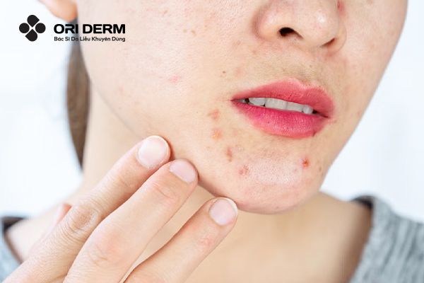 Các lưu ý khi trị mụn ẩn dưới cằm