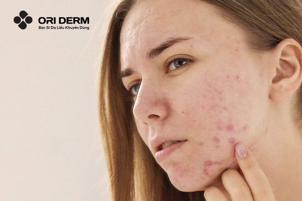 Các nguyên nhân hình thành sẹo lõm