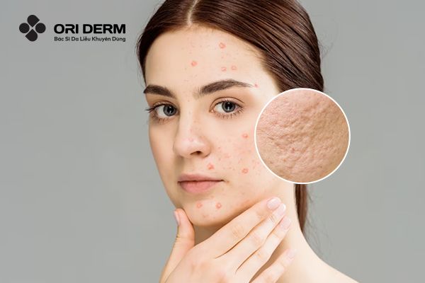 Sẹo Lõm Có Tự Đầy Không? 7 Cách Làm Đầy Sẹo Lõm Hiệu Quả