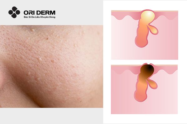 Cách nhận biết mụn ẩn