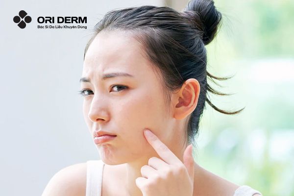 Cách xử lý khi mụn viêm bị vỡ