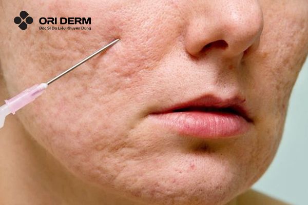 Cắt đáy sẹo lõm