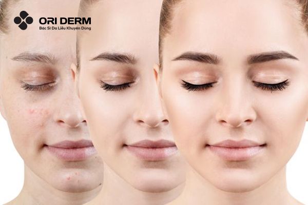 Chứa các thành phần hỗ trợ trị mụn