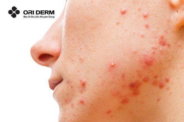 5 Cách Tiêu Diệt Các Ổ Mụn Viêm Hiệu Quả, Chuẩn Y Khoa