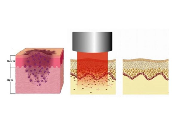 Cơ chế của laser trị thâm mụn