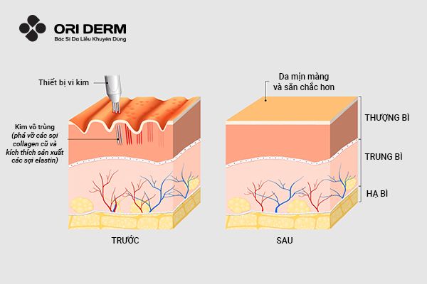 Cơ chế hoạt động của lăn kim