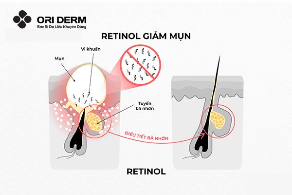 Cơ chế trị mụn của retinol