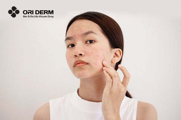 Da mụn có nên dùng sữa rửa mặt tạo bọt hay không?