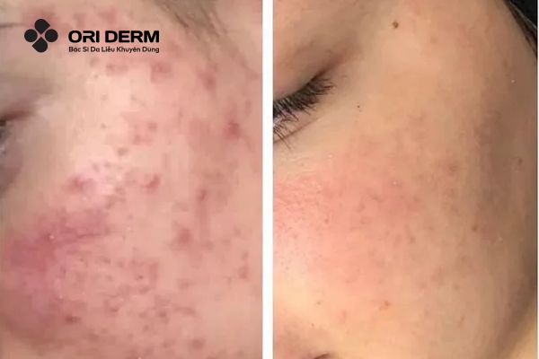 Công dụng của Retinol trong làm đẹp