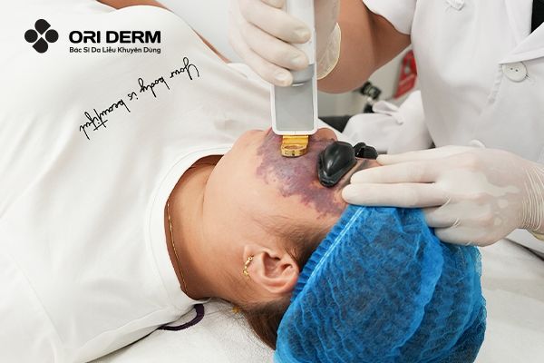 Laser YAG giảm nám và xóa vết bớt