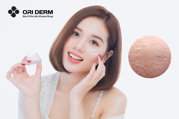 TOP 8 Kem Trị Mụn Ẩn Cho Da Dầu Và Những Lưu Ý Khi Dùng