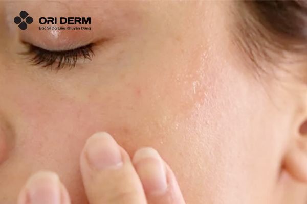 Da khô là gì? Các dạng da khô phổ biến