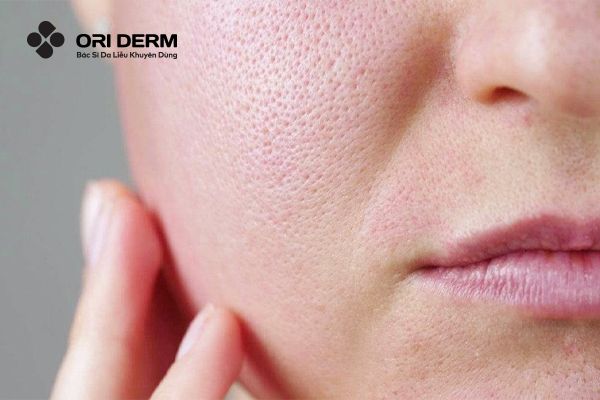 Da nhạy cảm là gì? Đặc điểm nhận biết làn da nhạy cảm