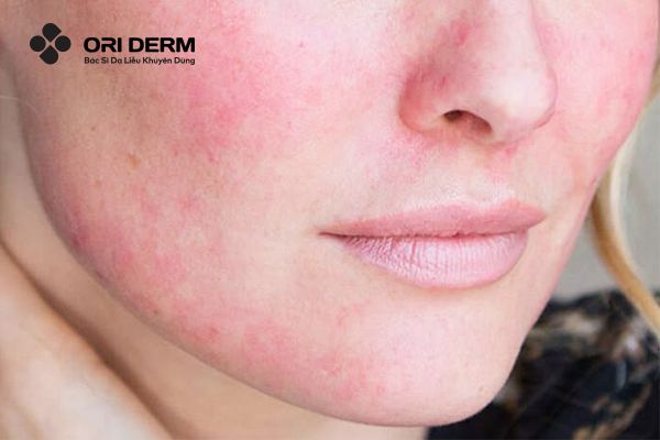 Da nhạy cảm là gì?