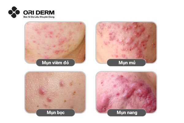 Mụn viêm là gì? Các loại mụn viêm phổ biến