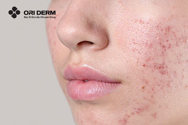 Đặc điểm của da dầu mụn