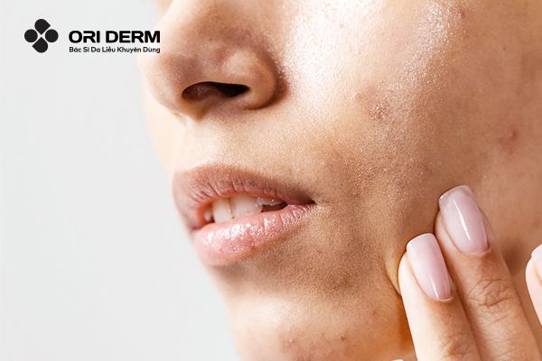 Đặc điểm của da dầu mụn