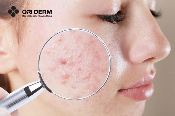 Đặc điểm của mụn ở má