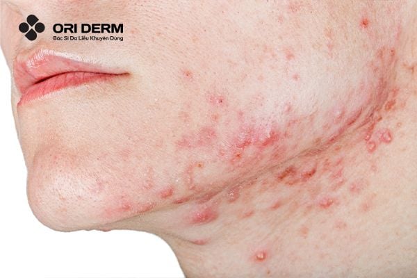 Đặc điểm của mụn ở quai hàm