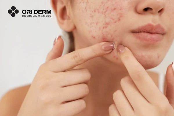 Nguyên nhân dẫn đến tình trạng mụn ẩn dưới da