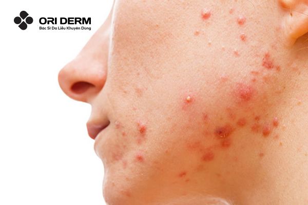 Biểu hiện nhận biết mụn nội tiết ở nữ