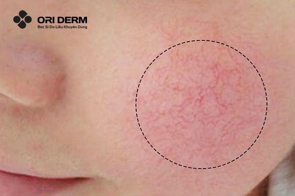 Dấu hiệu nhận biết da mỏng