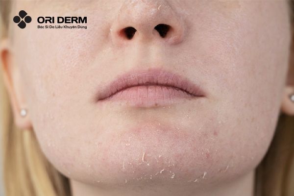 Dấu hiệu nhận biết làn da thiếu ẩm