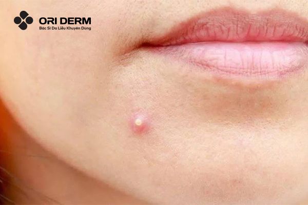 Dấu hiệu nhận biết mụn mủ viêm