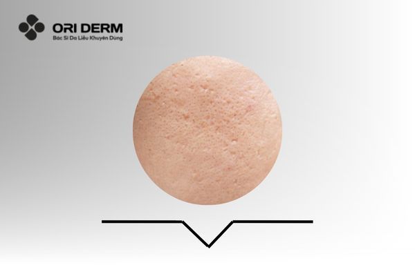 Dấu hiệu nhận biết sẹo lõm đáy nhọn