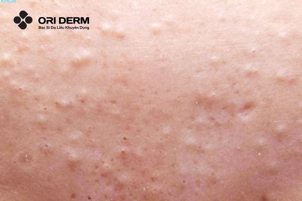 Đẩy mụn ẩn là gì?