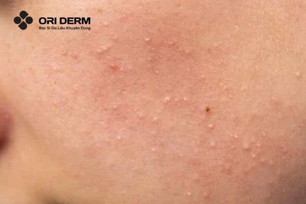 Đẩy mụn do nguyên lý hoạt động của AHA