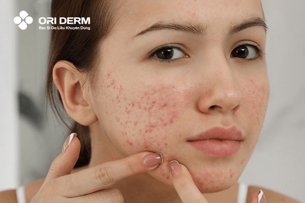 Dị ứng với BHA