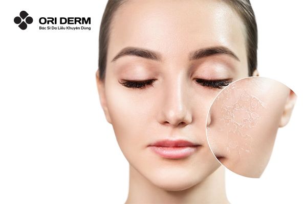 Đặc điểm của da hỗn hợp thiên khô