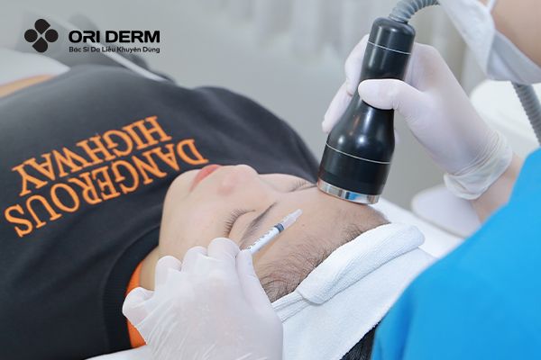 Điện di trị mụn viêm ở trán