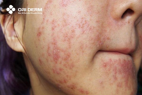 Dùng BHA bị kích ứng da